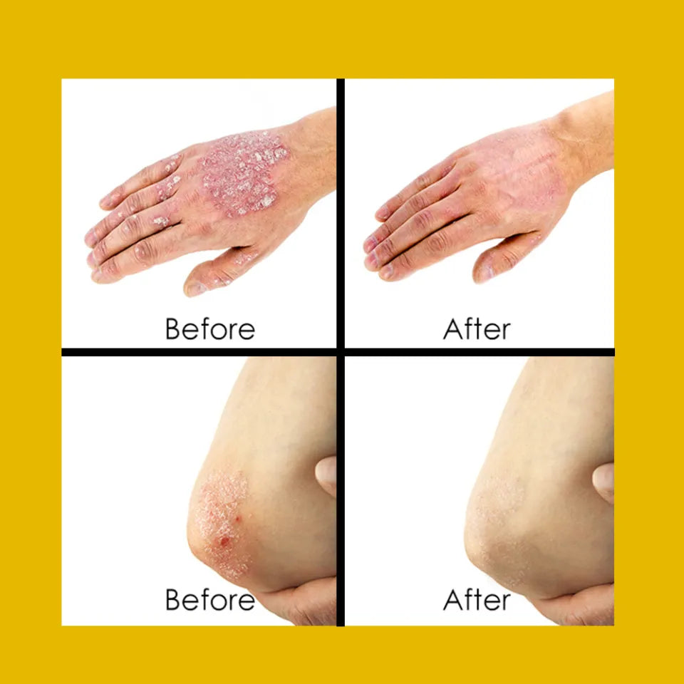 Psoriasis Cream