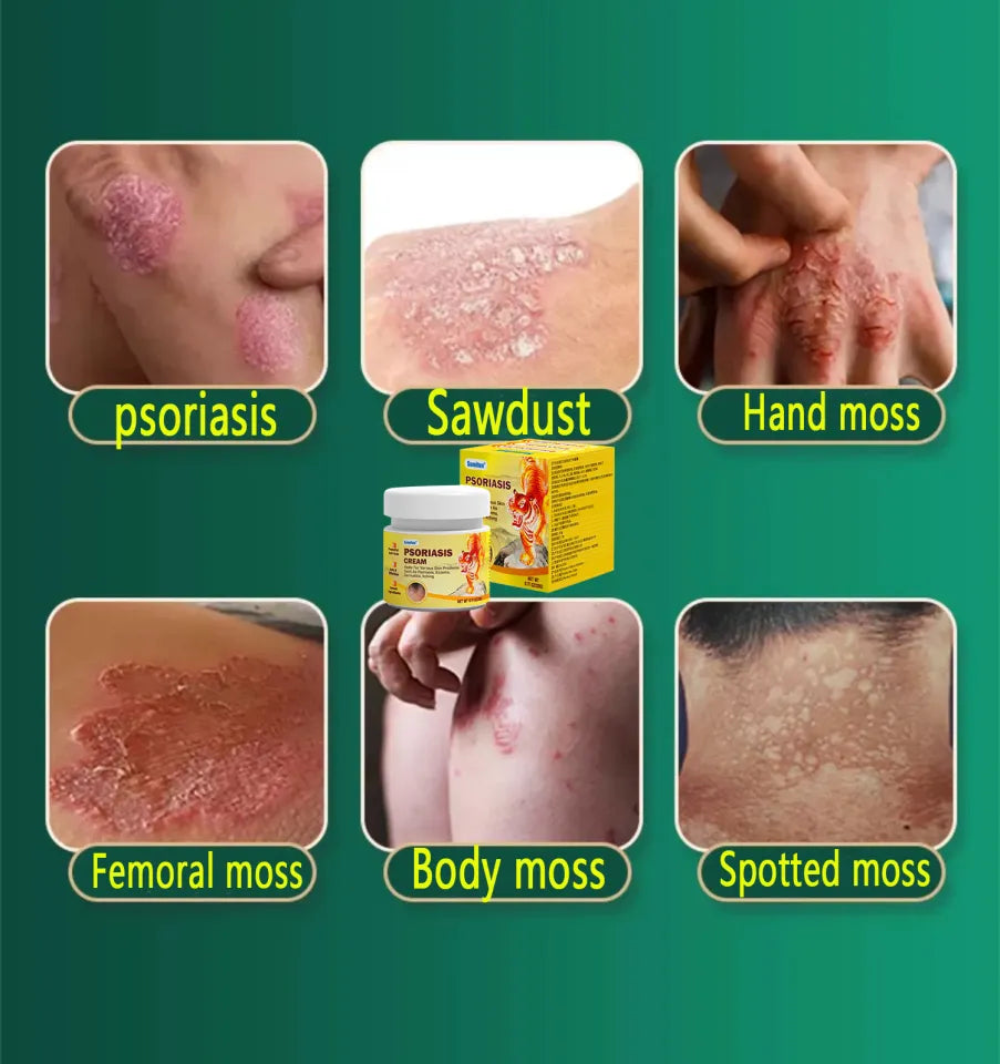 Psoriasis Cream