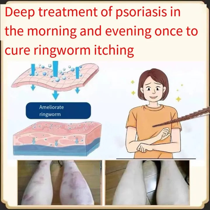 Psoriasis Cream