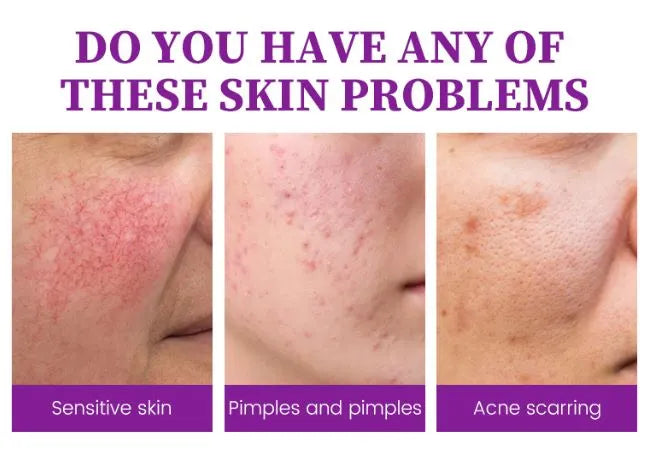 Beauty Anti Acne Fade Acne Marks Handmade Body and Face Soap-120g 4:1/ 4pc