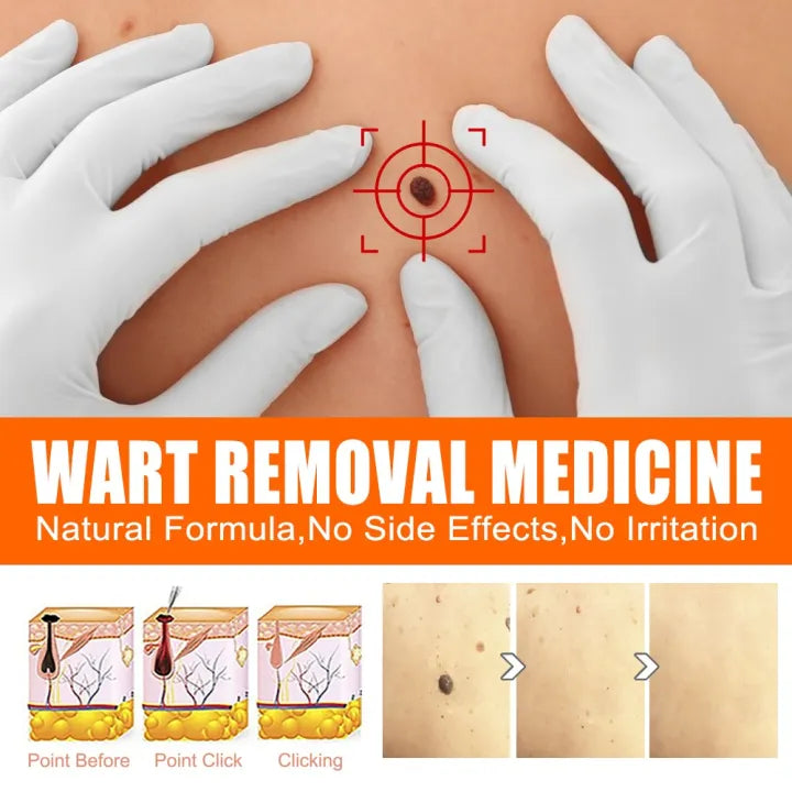 AICHUN BEAUTY | Anti - wart cream