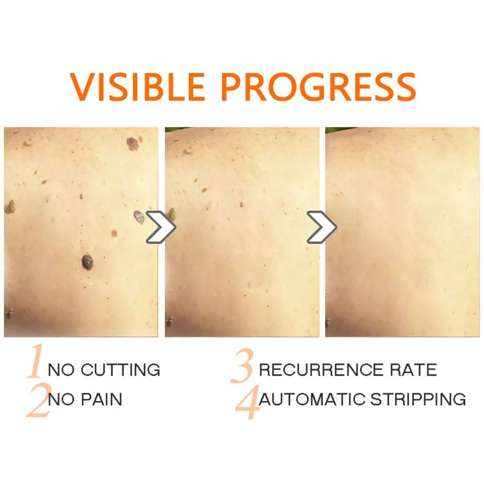 AICHUN BEAUTY | Anti - wart cream