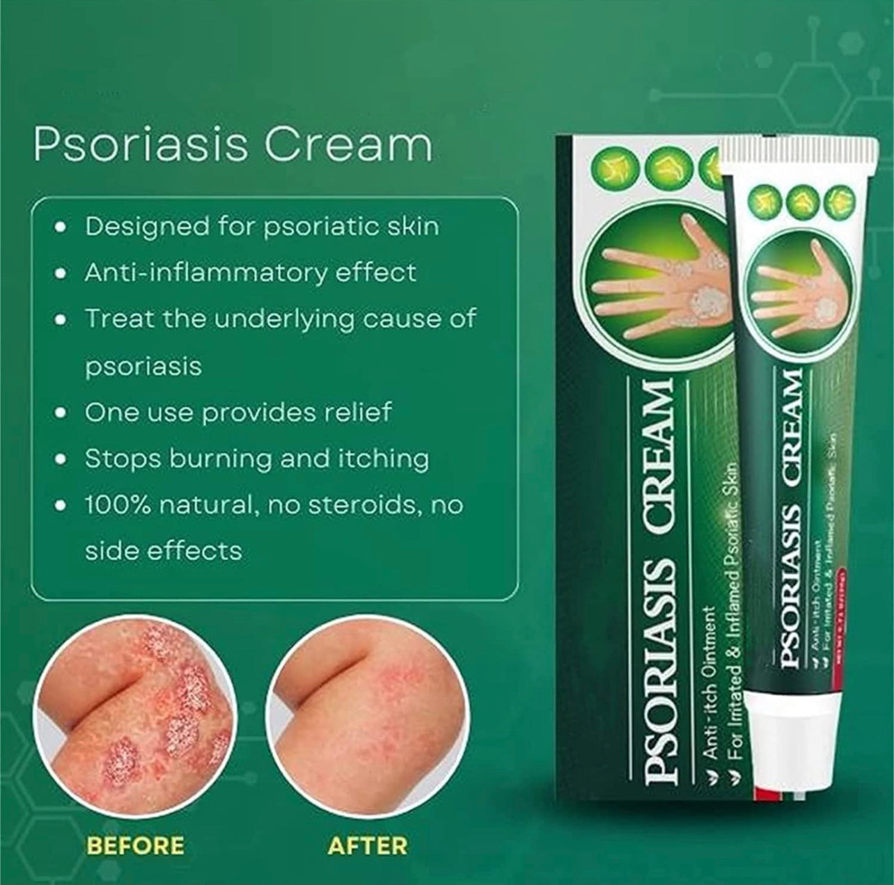 Skinmedix Psoriasis Cream, Zlimplify Psoriasis Cream, Psoriasis Control Face and Body Cream, Natural Chinese Herbal Eczema