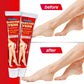 Sumifun Varicose Veins Ointment Vein Cream Veins For Treating Varicose Remover Effective & Original Cream Vasculitis Phlebitis Spider Pain Relief Plaster