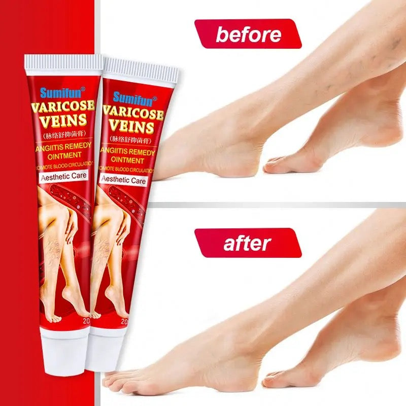 Sumifun Varicose Veins Ointment Vein Cream Veins For Treating Varicose Remover Effective & Original Cream Vasculitis Phlebitis Spider Pain Relief Plaster