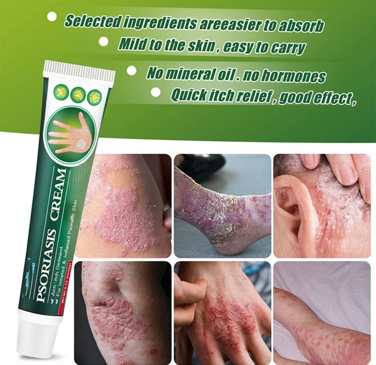 Skinmedix Psoriasis Cream, Zlimplify Psoriasis Cream, Psoriasis Control Face and Body Cream, Natural Chinese Herbal Eczema